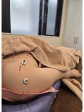 ムラサキ鍼灸治療院(MURASAKI鍼灸治療院)/五十肩にも鍼灸施術