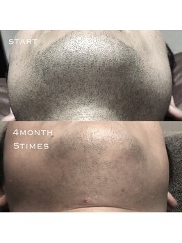 メンズプシュケ(men's PSYCHE)/ひげ脱毛