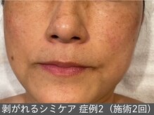 オアシスラグーン(OASIS LAGOON)/シミケア（症例2 施術2回）50代