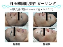 スパイア(SPIRE)/白玉韓国肌美白ピーリング