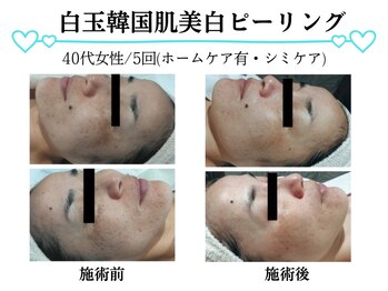 スパイア(SPIRE)/白玉韓国肌美白ピーリング