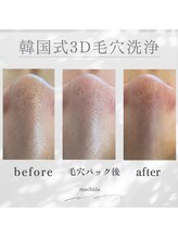 ホワイトニングショップ 町田店/毛穴洗浄ビフォーアフター1回