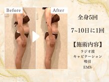 ミスティア(mistia)/【セルフエステBA】全身