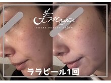 ビーマジック(美magic)/ララピール