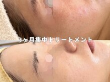 クラルテ(CLARTE)/1～3ヶ月集中トリートメント♪