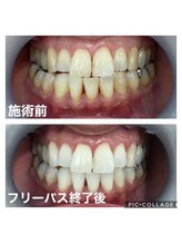 ホワイトニングサロン 京都烏丸店/ホワイトニング施術例