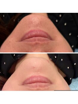 レイモード(Ray mode)/BBLフェイシャル、パック