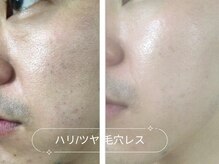 カラーデザインサロン(COLOR DESIGN SALON)の雰囲気（毛穴洗浄6回+美容液導入。男性にも大人気の毛穴ケア。）