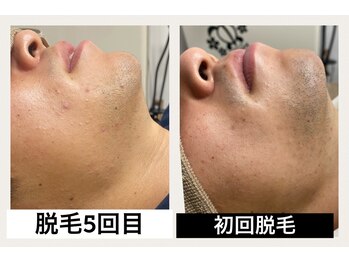 サロン ド チェリー 西町店(Salon de Cherry)/髭脱毛