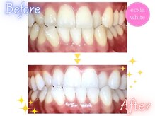 エクシアホワイトニング 町田店/ホワイトニングビフォーアフター