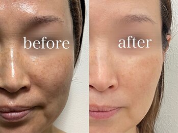 ルテア(Retea.)/【シミケア】光フェイシャル