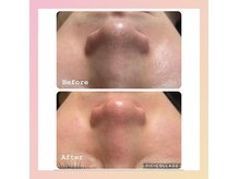コンフィデンスサロン(Confidence Salon)の雰囲気（【毛穴の黒ずみのケア】毛穴洗浄×ピーリング施術でツルツルへ♪）