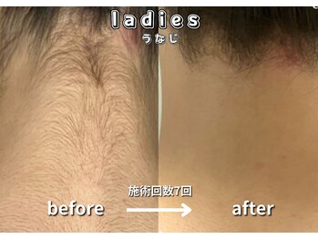 キュー(cue)/【レディース】「うなじ脱毛」