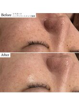 ミエル 神戸店(Miel)/シミケア/くすみ肌の改善には！