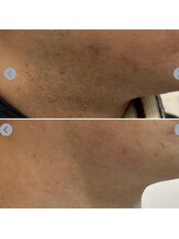 エピシアドットエヌ(epicia.N)/カミソリ負けも改善！