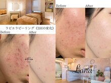 ラナ(Lana)