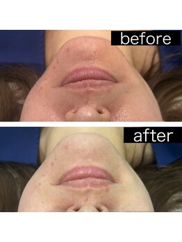 レイモード(Ray mode)/BBLフェイシャル&パック