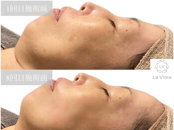 ラヴィオーラ 天神(La Viora)/ダイヤモンドハーブピーリング