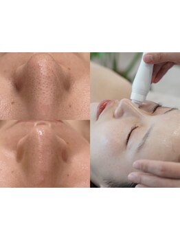 毛穴ケアをしたい