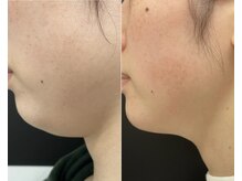 RiとBiのたまご/（フェイシャル）レモンボトル