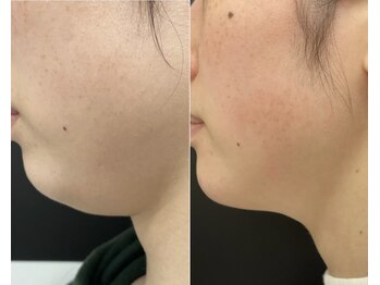 RiとBiのたまご/（フェイシャル）レモンボトル