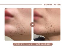 イエス マイサロン(yes My Salon)/プラズマホワイトシャワー施術例