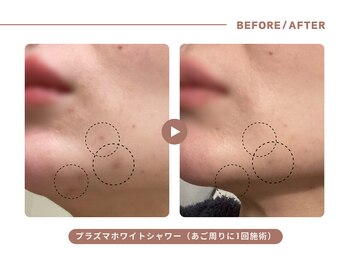 イエス マイサロン(yes My Salon)/プラズマホワイトシャワー施術例