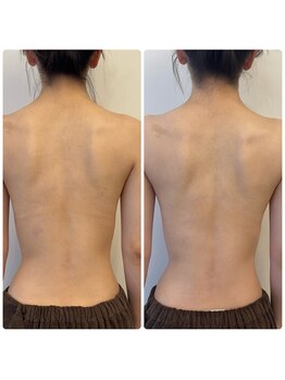 アレーズファイブフォー(A’LAISE54)/ブライダルハーブピーリング