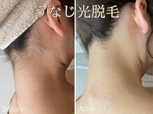 シエナ(ciena)/魅せる☆うなじ光脱毛♪