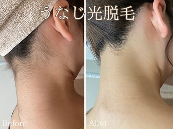 シエナ(ciena)/魅せる☆うなじ光脱毛♪