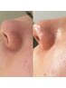毛穴の開きや黒ずみが気になる方向けの肌質改善体験￥5,000