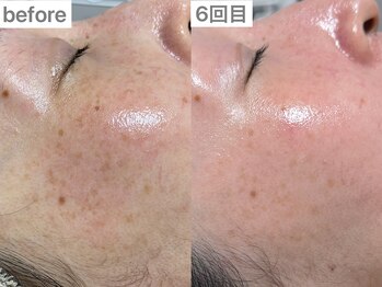 ユイット ルッカ(Huit Lucca)の写真/【最新機器】アクアダーマでお悩み別の独自のアンプルをお肌の深部まで導入し、あらゆる肌悩みを徹底解決☆