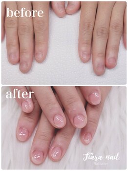 ティアラネイル 宇都宮/リプロネイル深爪矯正