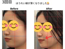 ベル/20代の方の小顔Before After