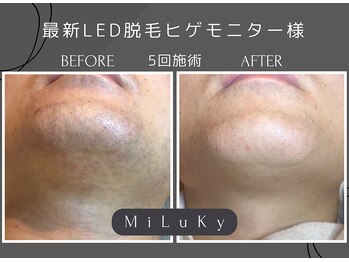 ミルキー(MiLuKy)/ヒゲ脱毛