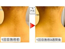 フィズ 明大前店(FIS)/☆気になるうなじの脱毛も☆