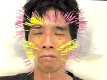 とだ鍼灸院/頭/目/顎のコリ/口角up 美容鍼◎