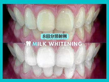 ミルクホワイトニング 久留米店(Milkホワイトニング)/★施術例