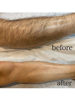 アートシェリモ(ART CHERIMO)/【メンズ脱毛】