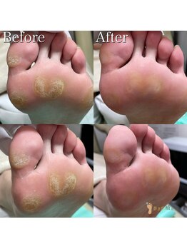 巻き爪補正店 越谷店/タコ・魚の目ケア