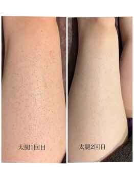 ラック(lac)/メンズ脚脱毛