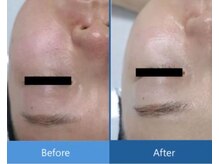 リノア 柏(Lino'a)/しわたるみ/ほうれい線に。