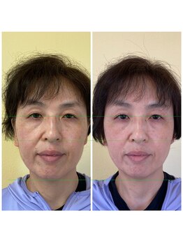 ハーボプラス(THE HEARBO plus)/やっぱり定期的メンテは大事