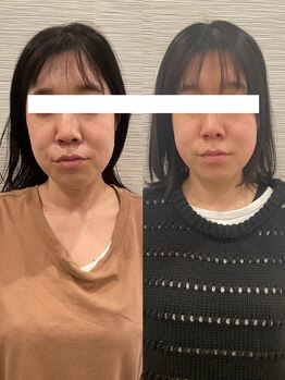 長寿鍼灸院 長寿整骨院/美容鍼100本の効果★（ 2回目）