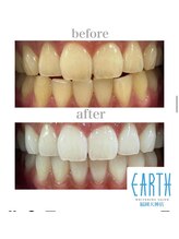 アース 福岡天神店(EARTH)/before　after　【美白