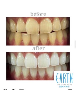 アース 福岡天神店(EARTH)/before　after　【美白