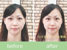 ひびきレディース整体 日吉/顔のむくみ卒業！美花嫁小顔矯正