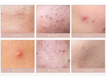 モカラ(MOKARA)/ニキビの種類