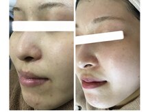 モカ 天王寺店(MOKA)/剥離　ニキビケア　予防