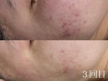 ホワイトアクア 北千住店(WHITE AQUA)/ハーブピーリング3回